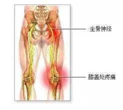 腰椎间盘突出和腰肌劳损您是哪个？