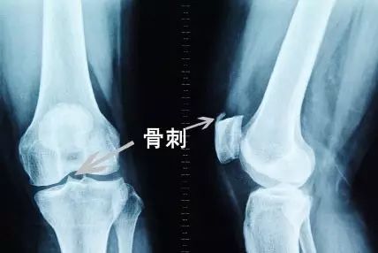 骨刺到底是什么“刺”？