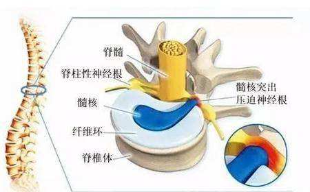射频臭氧腰间盘消融术 —腰间盘突出症微创治疗方案之一