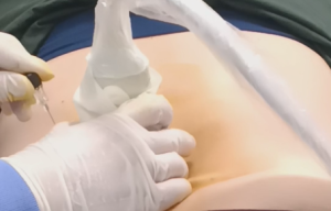 腰椎超声引导