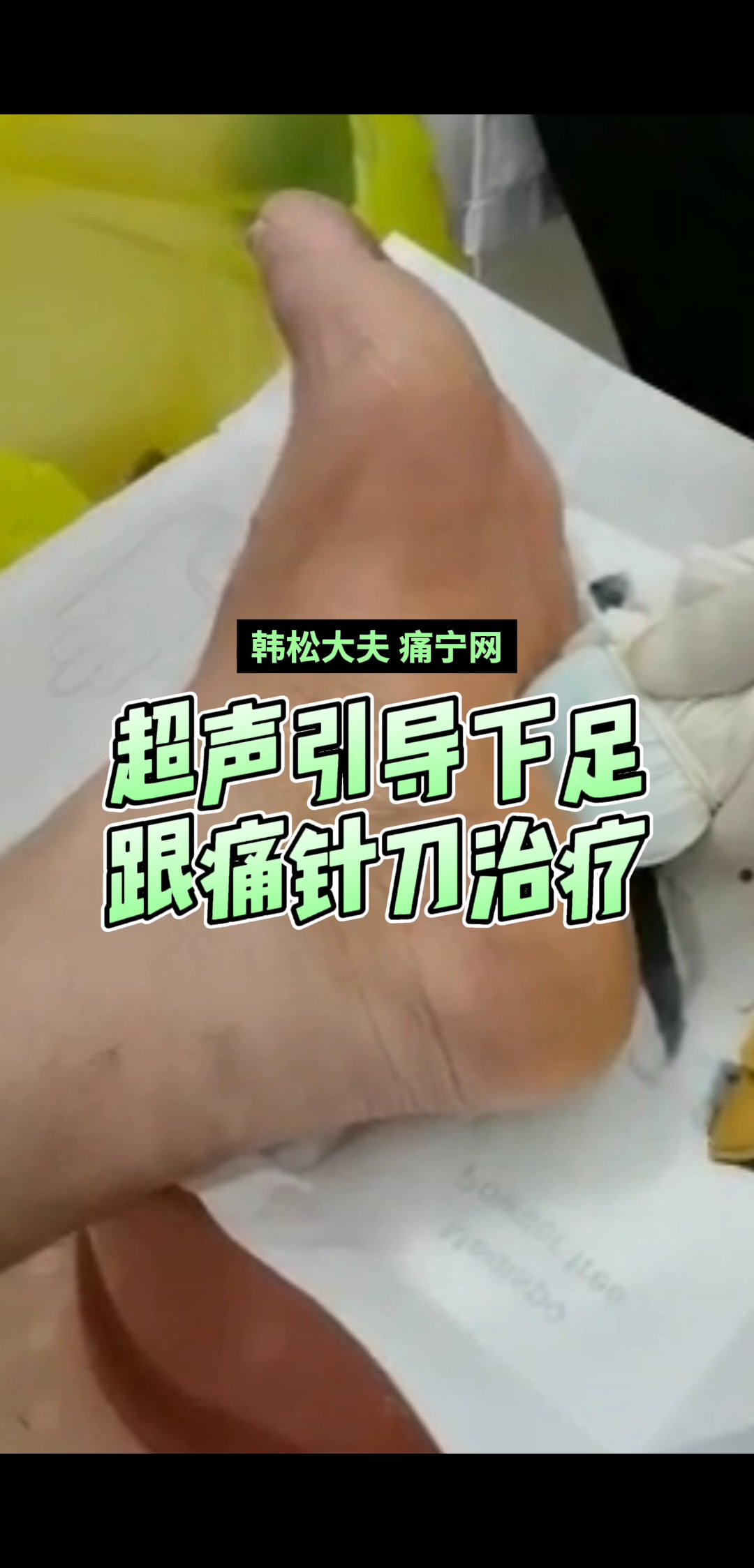 超声导引下足跟痛针刀治疗