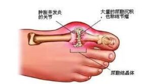 痛风