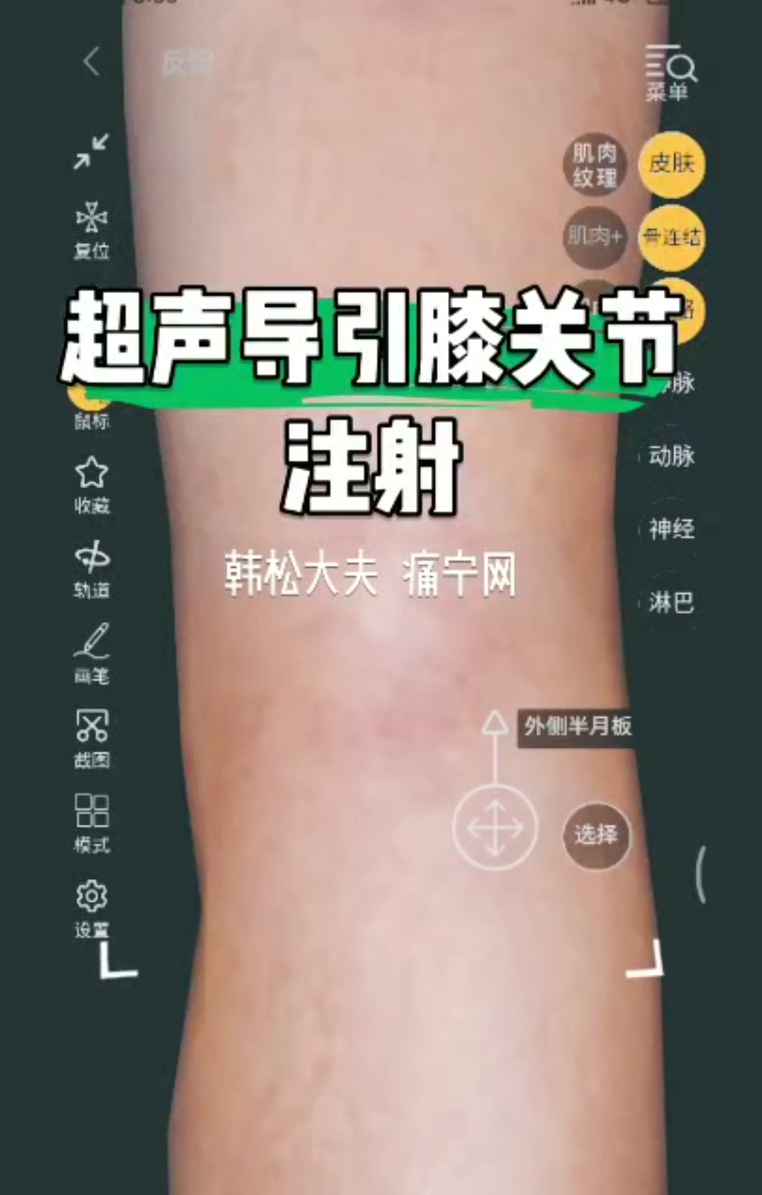 超声导引膝关节注射