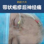 带状疱疹神经痛电针治疗