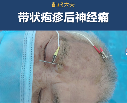 头面带状疱疹后神经痛电针治疗