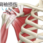 肩袖损伤
