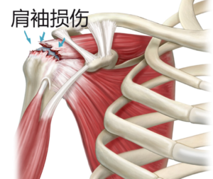 肩袖损伤