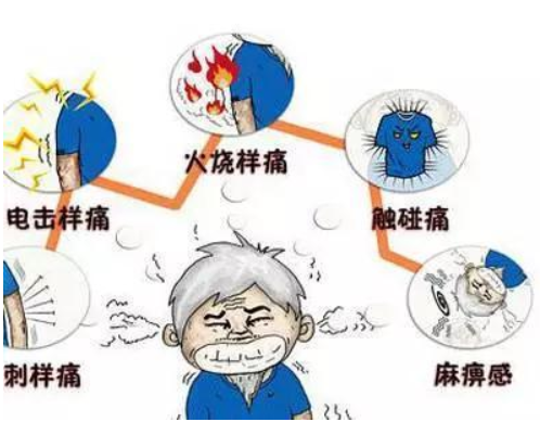 带状疱疹后遗痛不需忌口