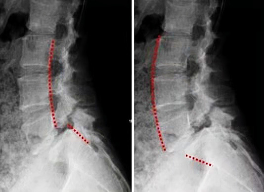 腰椎滑脱可以导致慢性腰痛