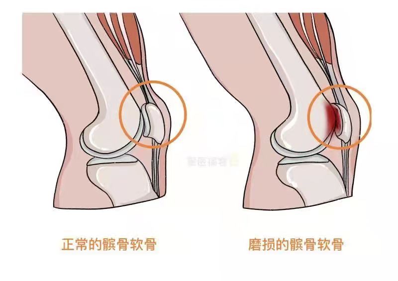 髌骨软化症是严重疾病吗？