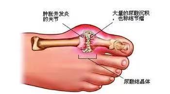 痛风基层合理用药指南