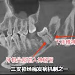 牙导致三叉神经痛