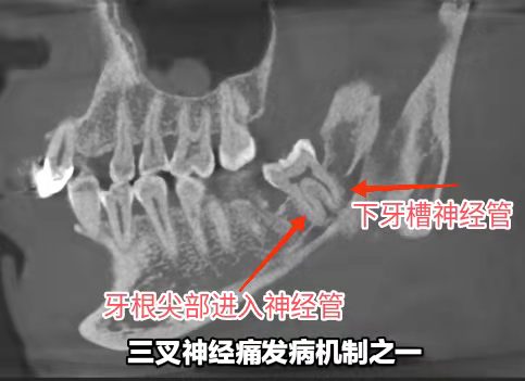 牙病可以导致三叉神经痛