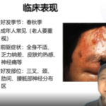 带状疱疹要点