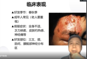 带状疱疹要点