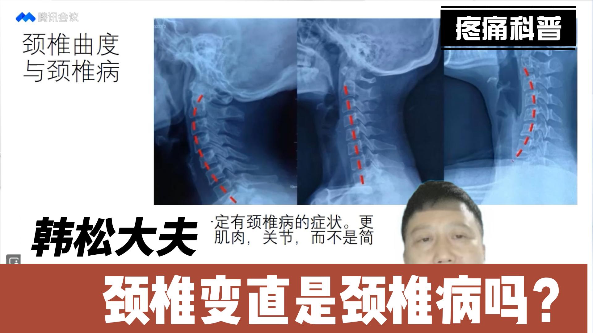 颈椎变直是颈椎病吗
