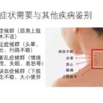 颈椎病的一些常见误区