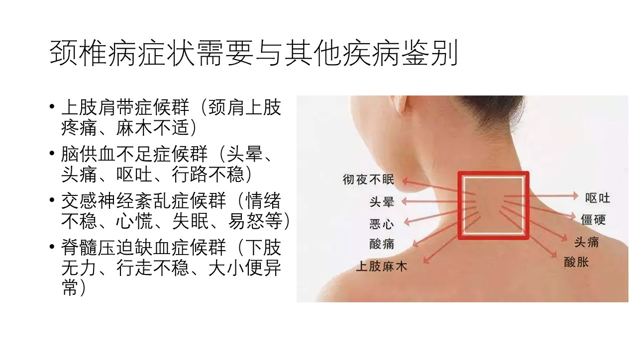 颈椎病症状需与其他疾病鉴别