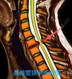 颈椎管狭窄示意图