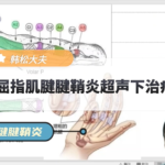 屈指肌腱腱鞘炎