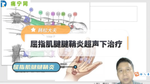 屈指肌腱腱鞘炎