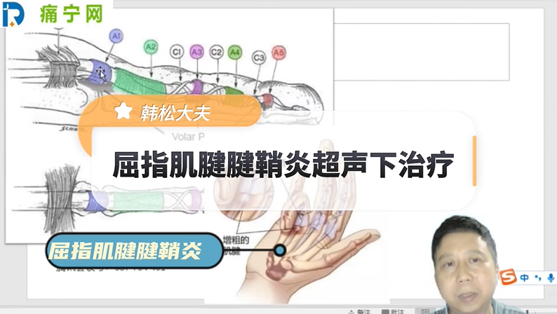 屈指肌腱腱鞘炎超声下治疗