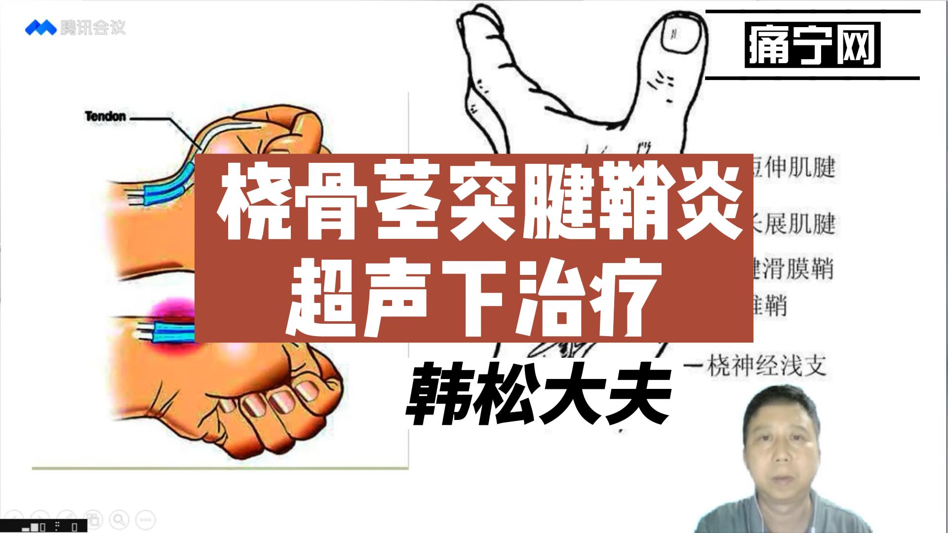 桡骨茎突腱鞘炎超声下治疗