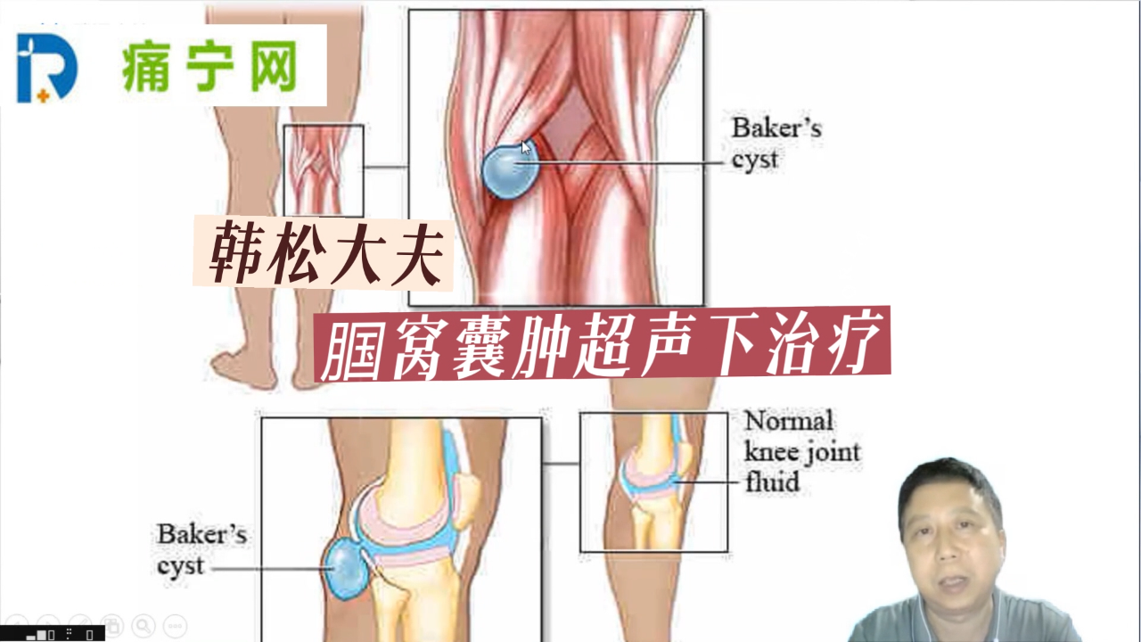 腘窝囊肿的超声下治疗