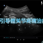 超声引导髋关节