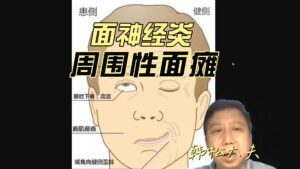 面神经炎