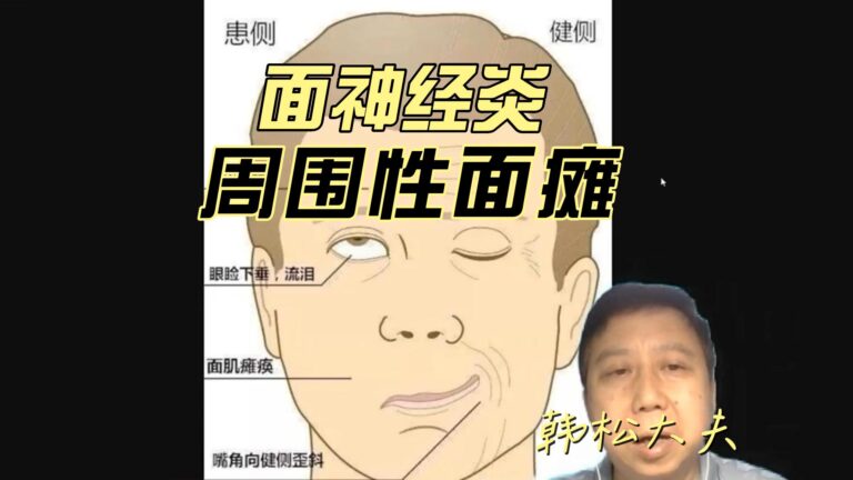 面神经炎
