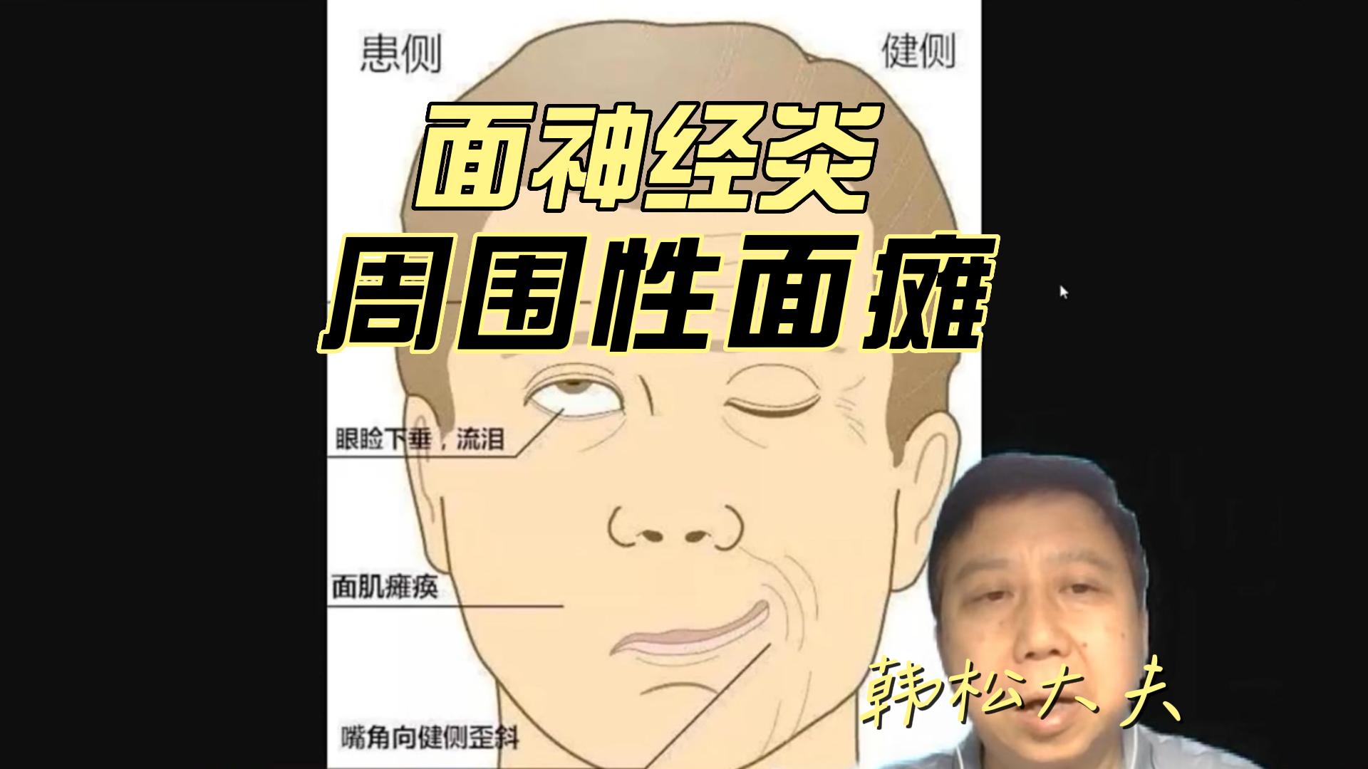 面神经炎-常见周围性面瘫