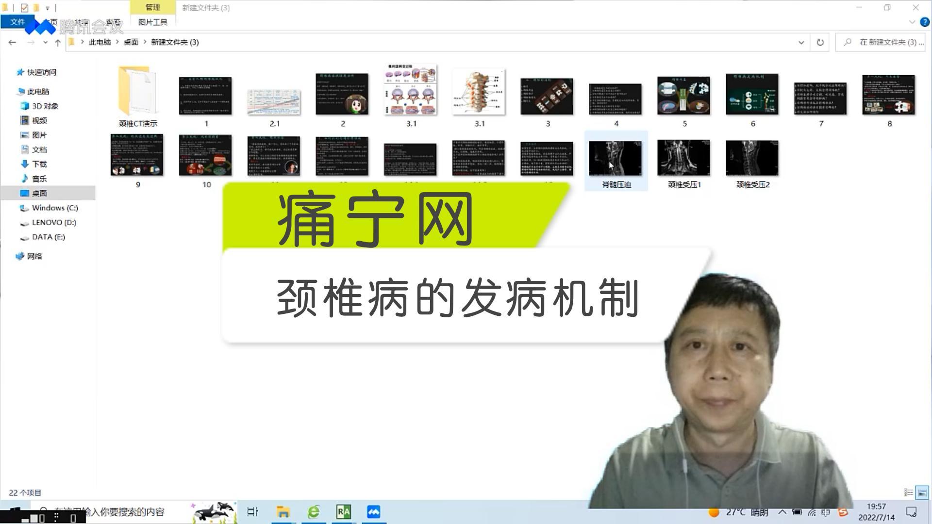 颈椎病的发病机制