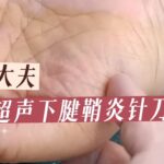 腱鞘炎针刀