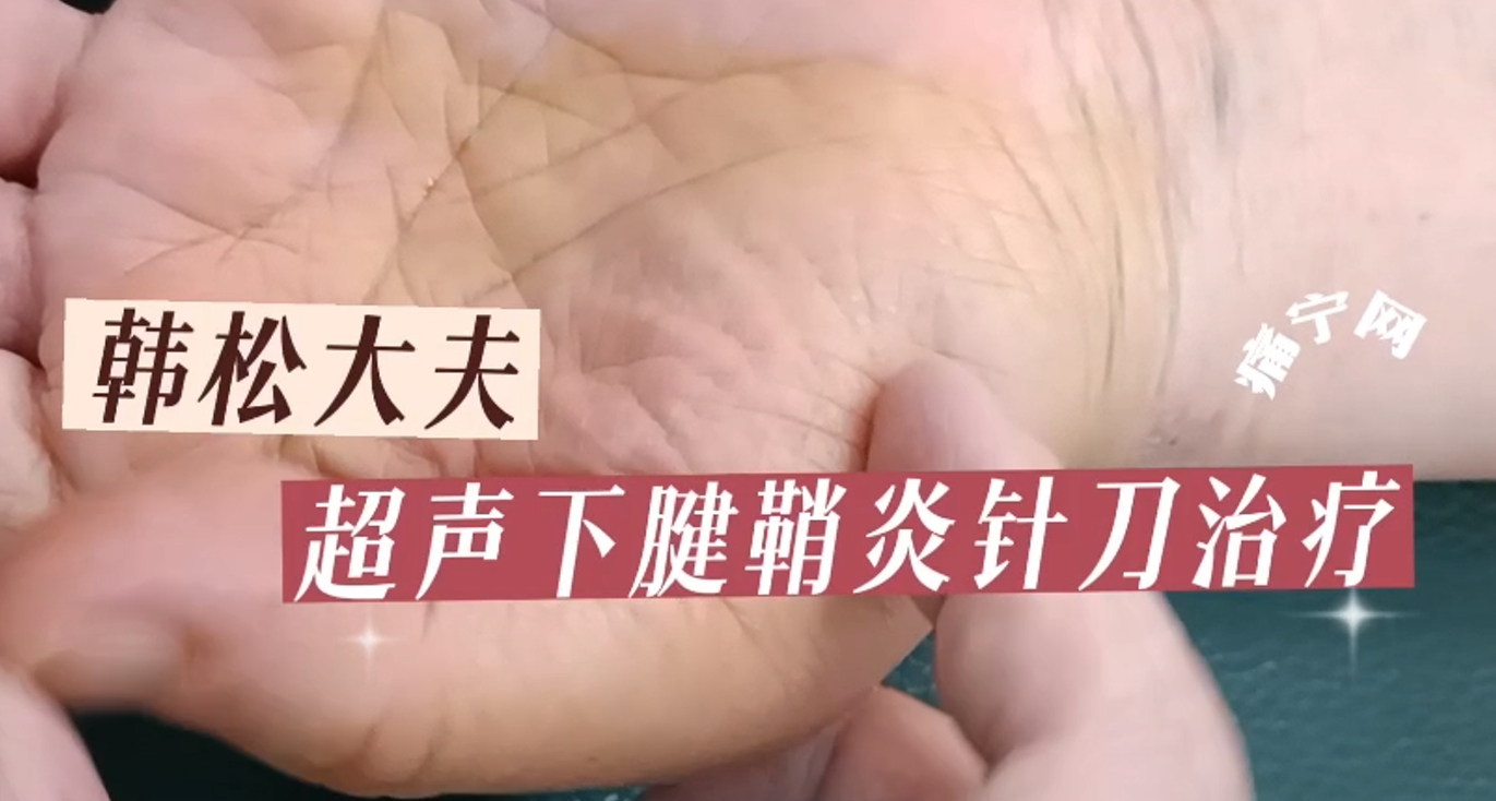 超声下腱鞘炎针刀治疗