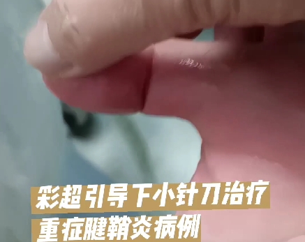 严重卡顿的拇指腱鞘炎