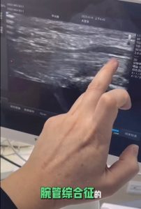 腕管综合征超声