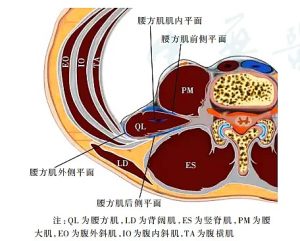腰方肌阻滞