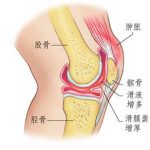 膝关节滑膜炎