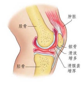 膝关节滑膜炎