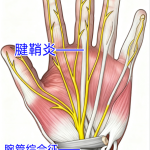 腕管综合征腱鞘炎