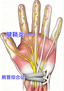 腕管综合征腱鞘炎