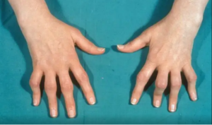 腕管腱鞘炎3