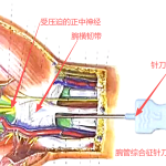 针刀松解腕横韧带示意图
