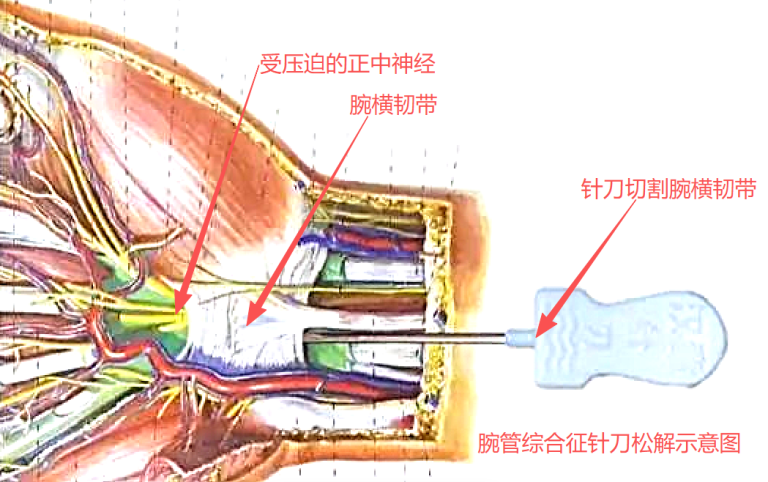 针刀松解腕横韧带示意图