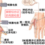腕管综合征肌电图