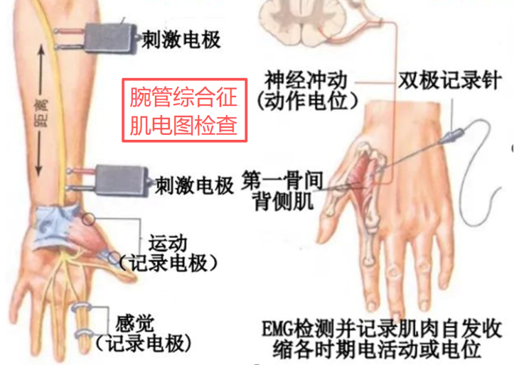 腕管综合征肌电图