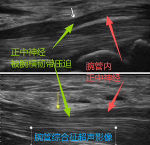 腕管综合征超声