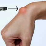 腕部囊肿