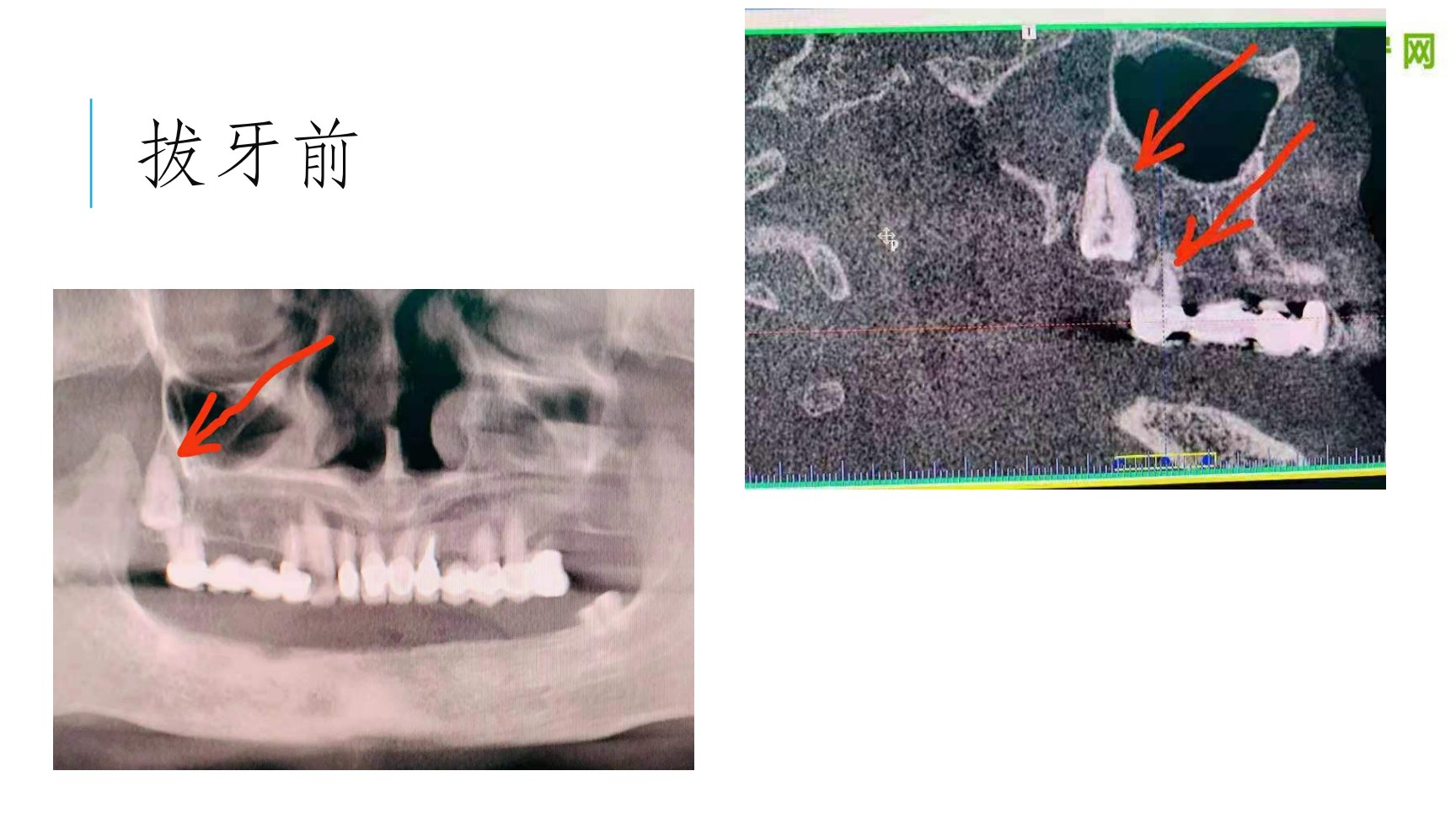 病例1 拔牙前:曲面断层与薄层CT,箭头示病变牙根